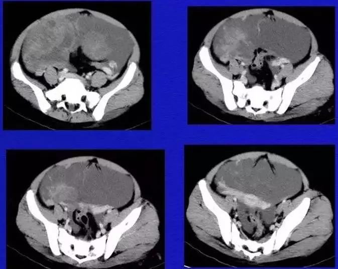 卵巢原发肿瘤的分析思路
