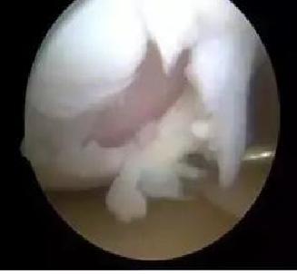 膝关节软骨移植手术风险大吗,膝关节软骨移植手术后多久能康复