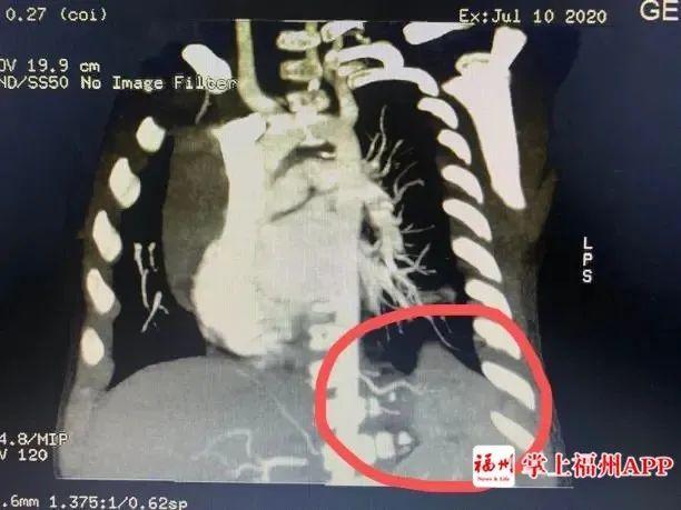 宝宝咳嗽伴有反复发烧福州,1岁8个月宝宝反复发烧肺部有痰