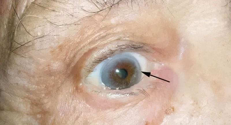 心血管病人眼睛肿怎么回事,心血管疾病引起眼皮水肿严重吗