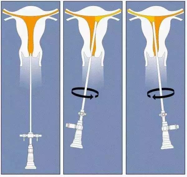 宫腔镜检查可怕吗,妇科医院的宫腔镜检查靠谱吗