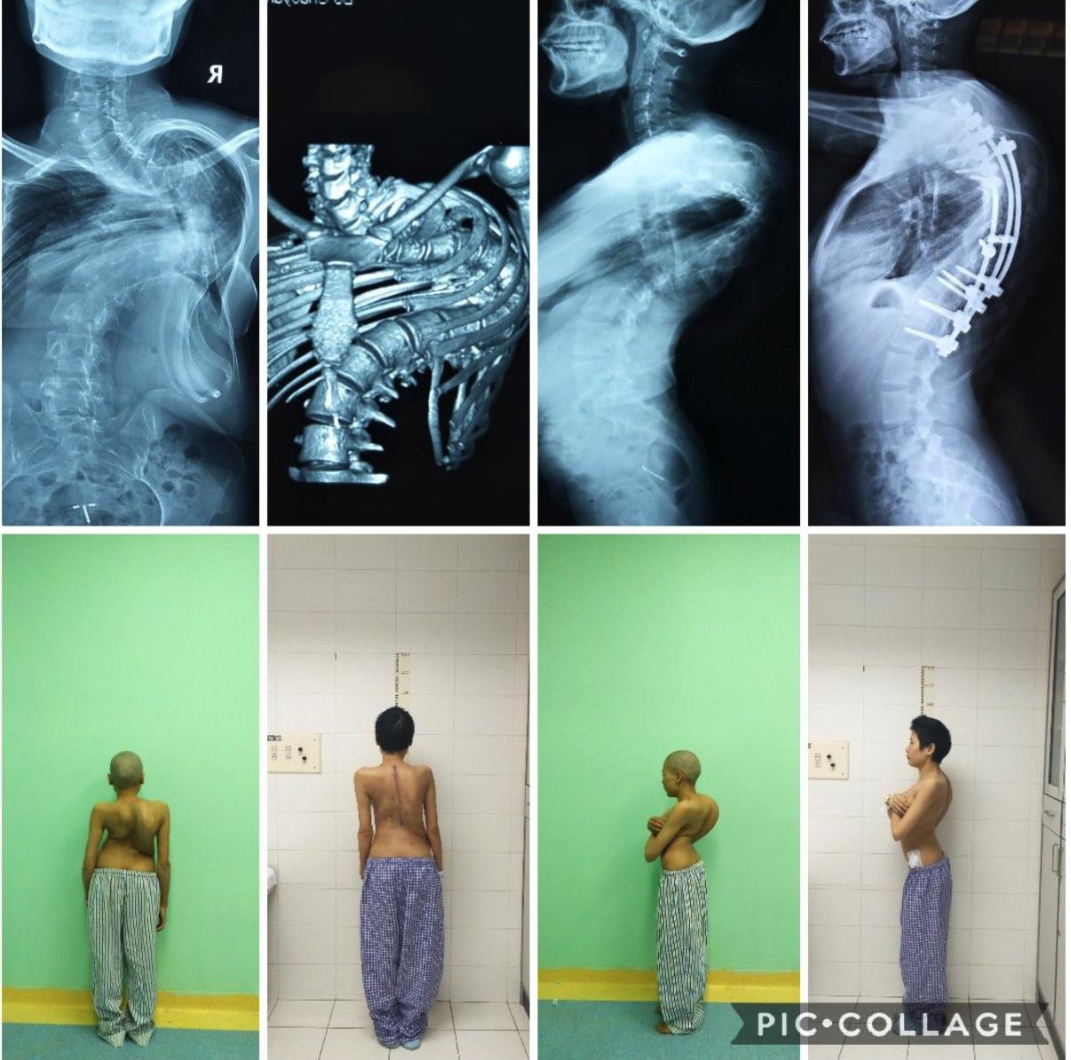 北京青少年脊柱侧弯矫正最佳方法,北京脊柱侧弯校正