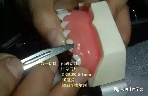 松牙固定需要什么条件,钢丝松牙固定操作流程