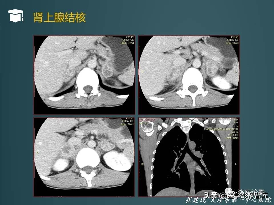 左侧肾上腺结节考虑腺瘤与增生,双侧肾上腺增生是什么原因造成的