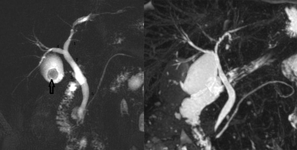 胆道系统解剖生理讲课视频,超声胆道系统的解剖生理