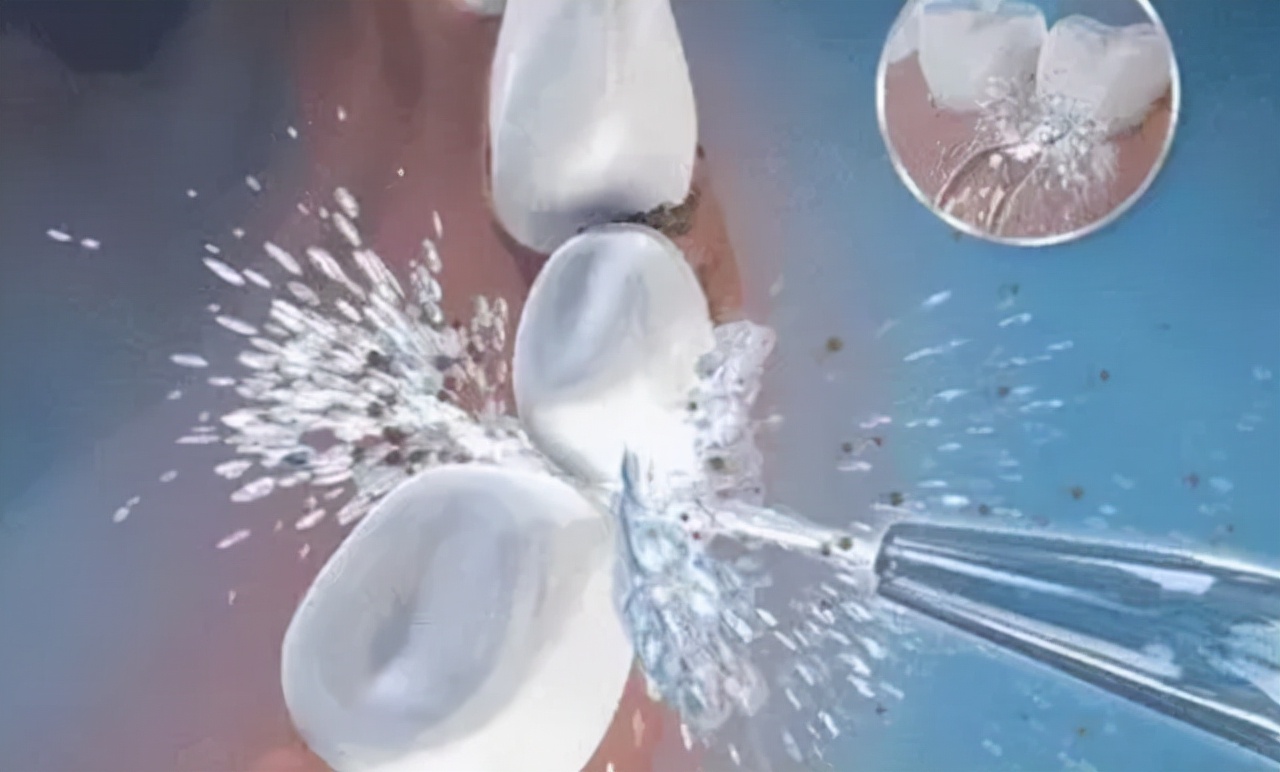 内侧牙缝的牙结石被我抠掉了,牙缝的黑色是牙结石吗可以抠掉吗