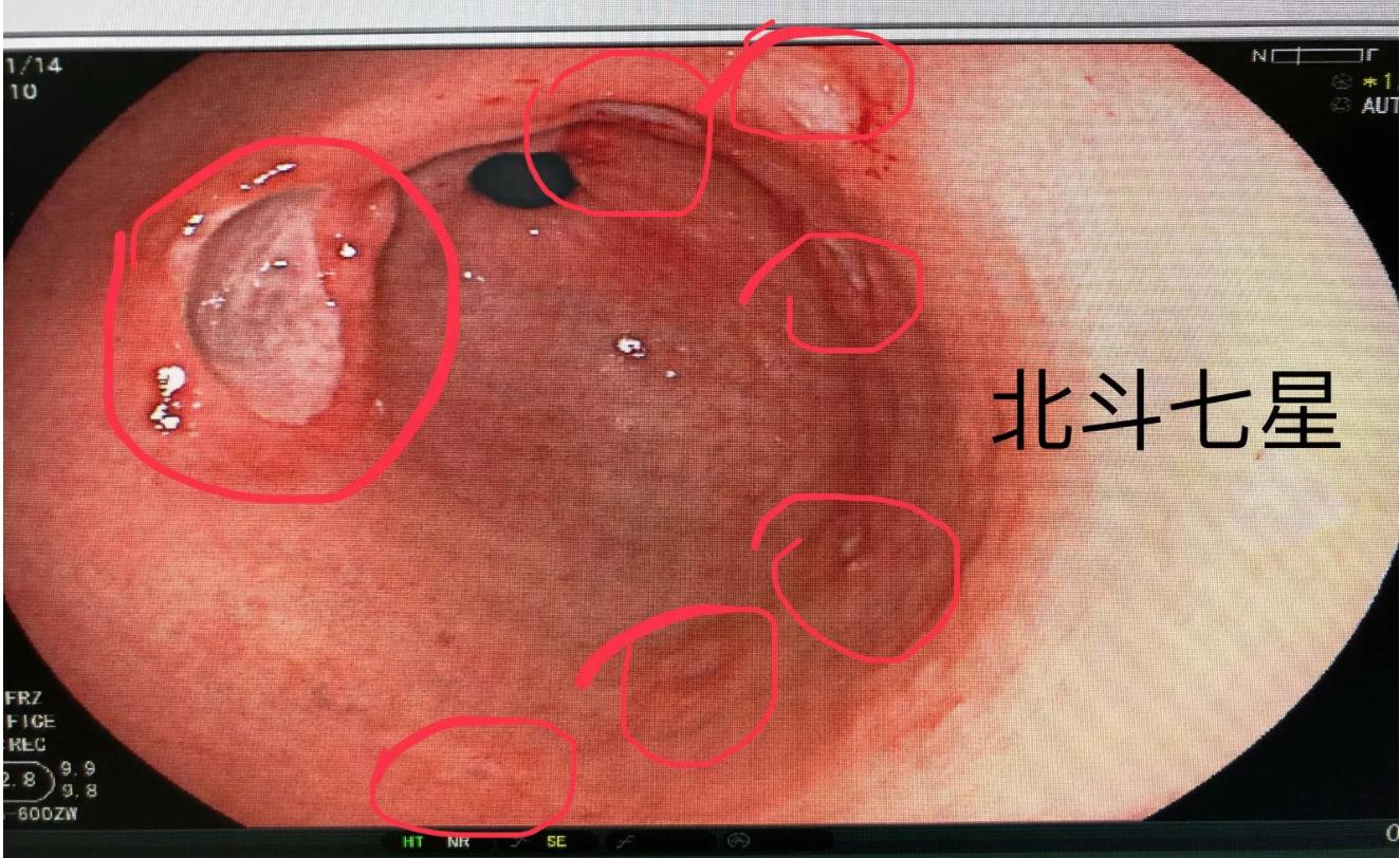 胃为什么吃得太饱就反酸顶气,胃为啥消化那么快