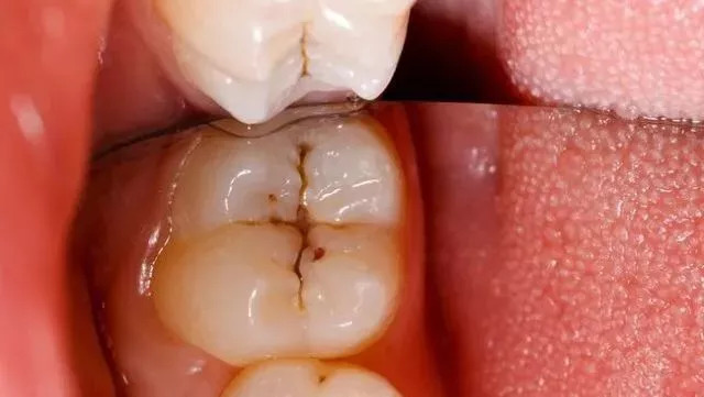 牙齿有黑斑点刷不掉怎么办,牙齿有黑线刷不掉怎么办