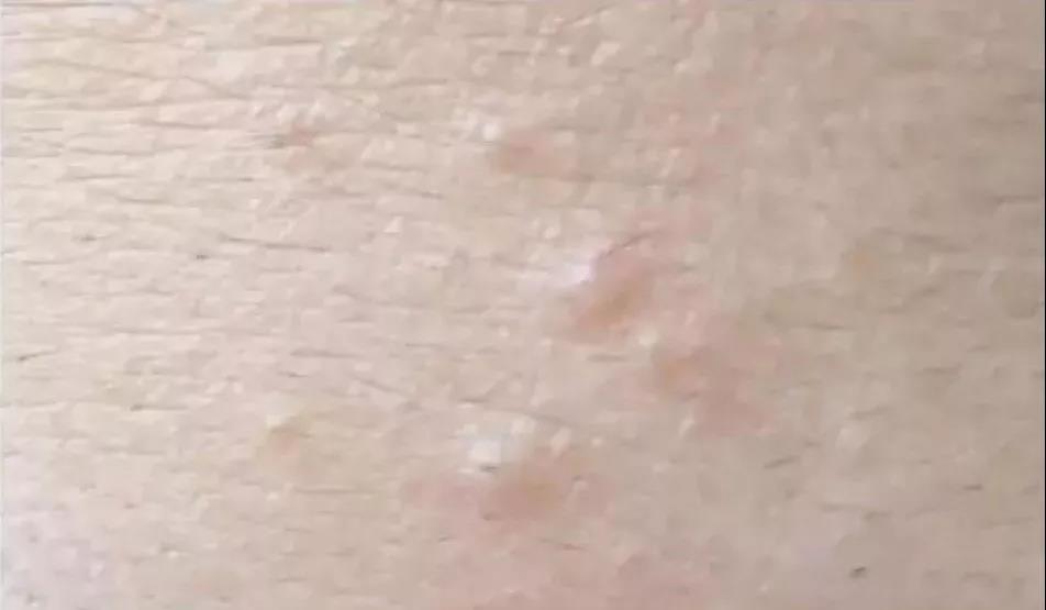 额头长了个小痘痘是什么,额头有小毛毛怎么长出来