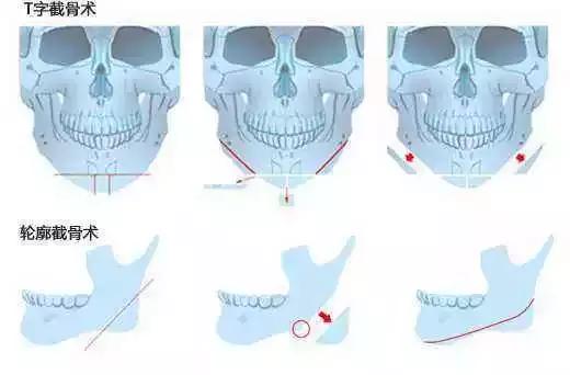 日式小颜整骨需要具备什么,日式小颜整骨术可以把额头变宽吗