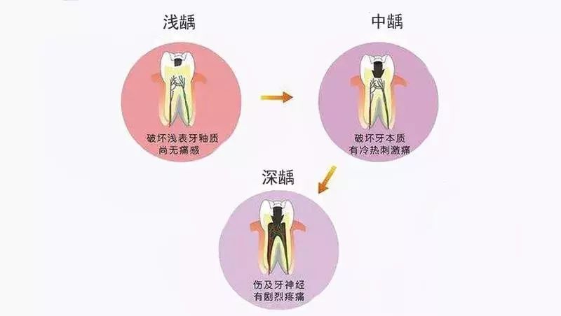 可复性牙髓炎和不可复性牙髓炎,急性牙髓炎和慢性牙髓炎的区别
