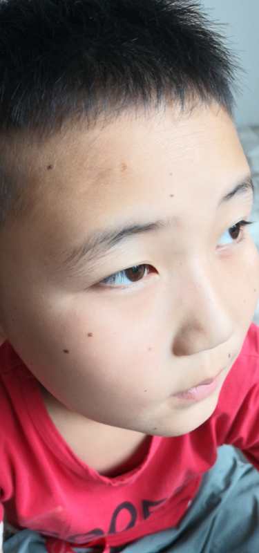 小儿色素沉着能消退吗,小孩子的色素痣着急处理吗