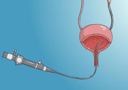 得了结石不要怕医生教你用中药,得了结石不要吃什么