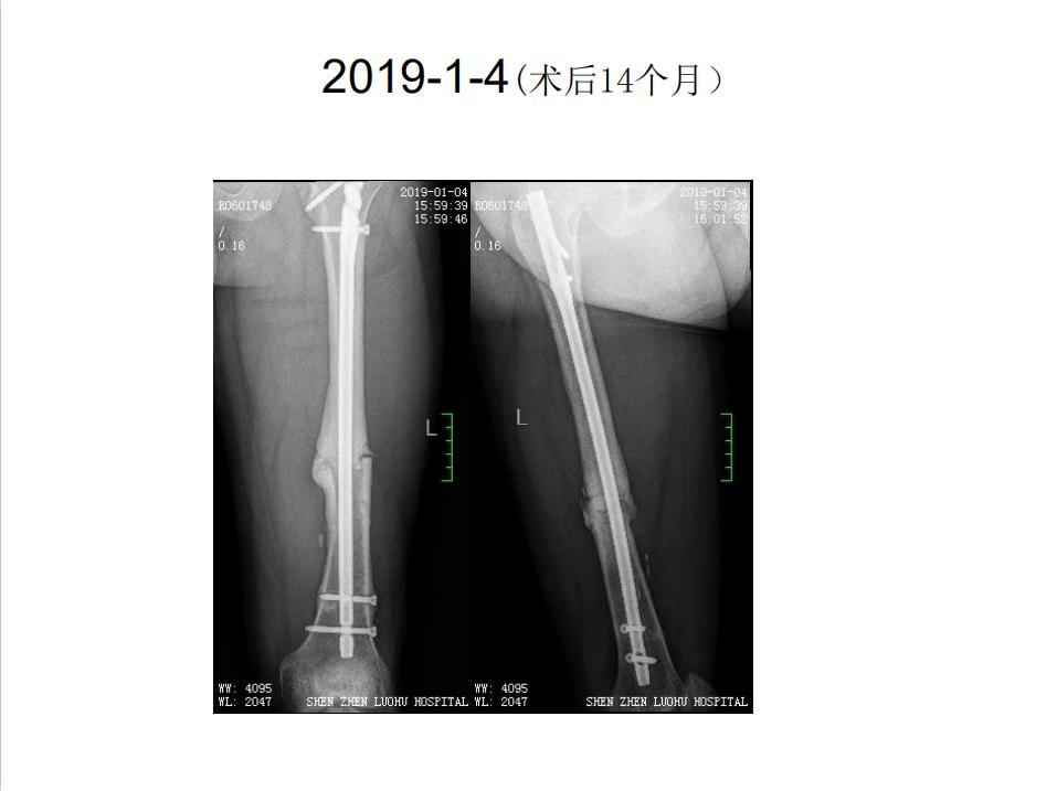 平乐骨科推拿教学,中医治疗骨折畸形愈合