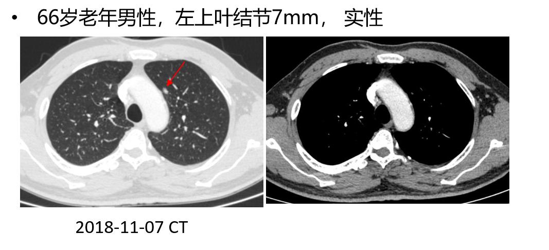 孙加源门诊,治疗肺癌的新技术新手段