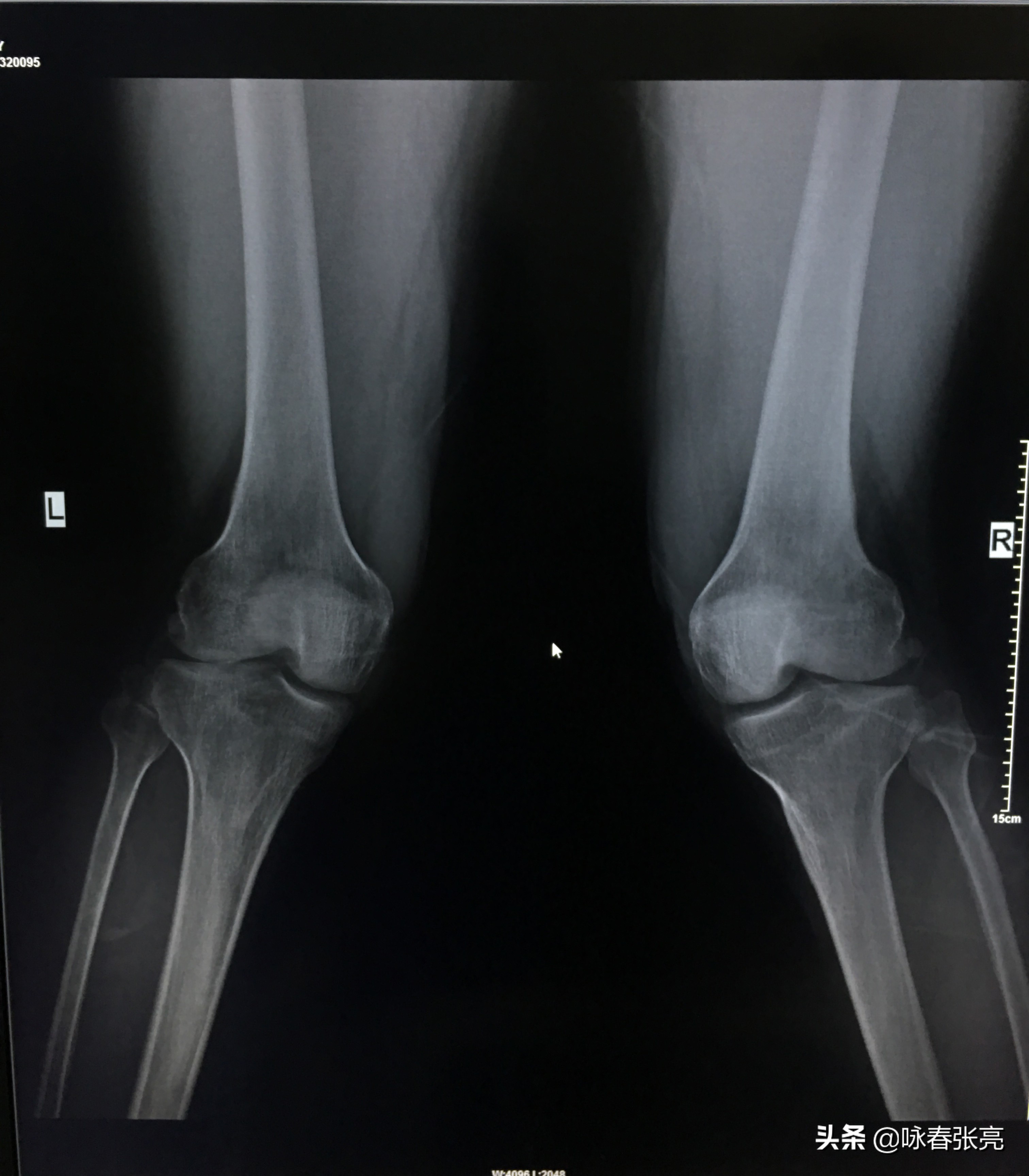 马步蹲怎样不伤膝,马步脚尖朝里还是朝外不伤膝