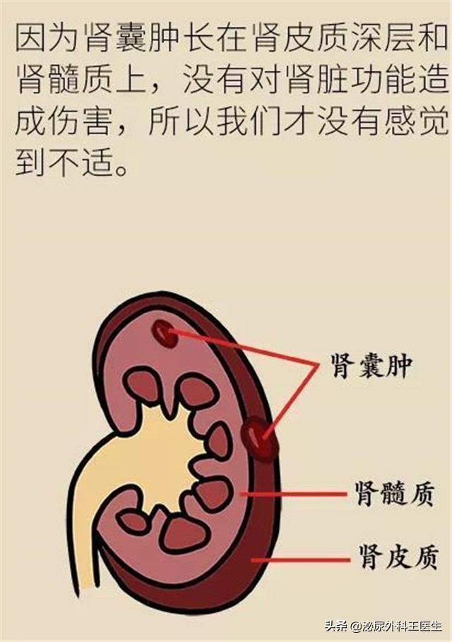体检发现肾囊肿怎么办,体检中常见肾囊肿怎么治疗