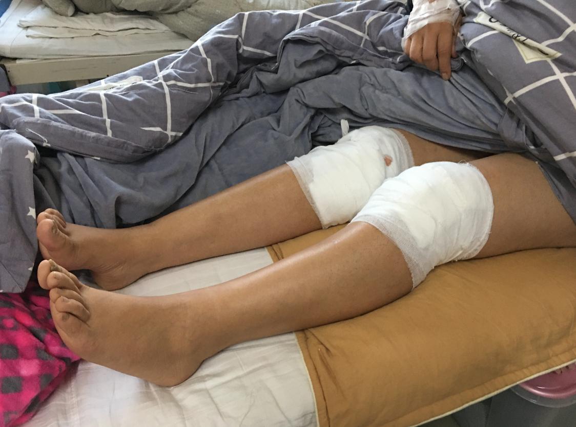 河南杞县115人针灸后针眼溃烂：针灸前被注射药物，事发后仍有人苦求继续针灸，患者需手术切开伤口排脓