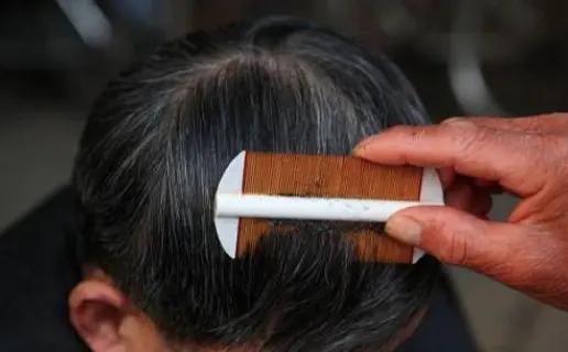 三十年前的虱子为什么消失了,虱子为什么八十年代多