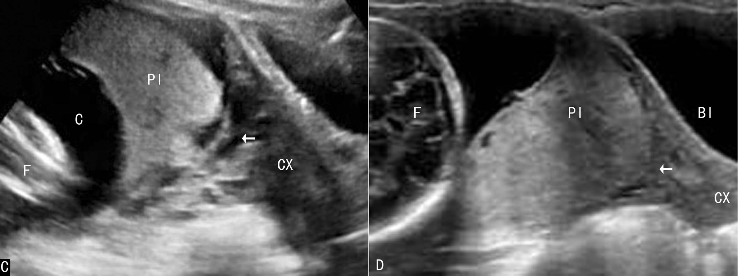 超声如何诊断前置胎盘,前置胎盘核磁报告显示胎盘无异常