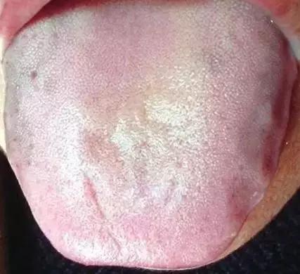 舌头中间有裂纹边有齿痕怎么回事,舌头中间有裂纹边缘锯齿怎么回事