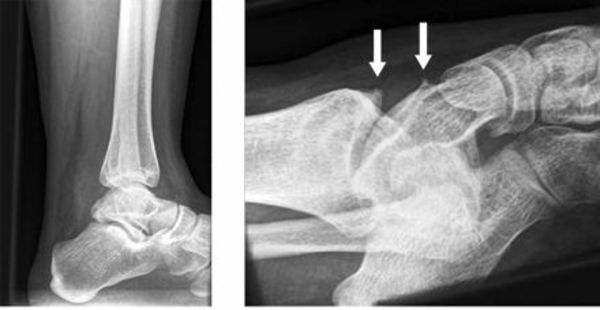 膝盖边有骨刺和增生用什么方法治,膝盖增生骨刺疼怎么治疗吃什么药