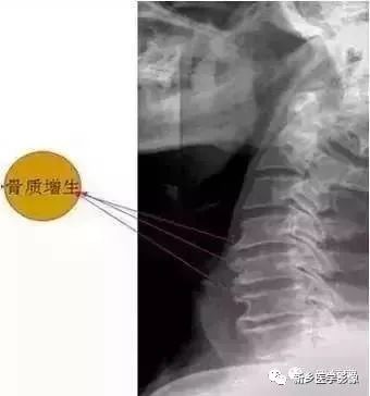 肘关节x线解剖,颈椎x线图片与讲解大全