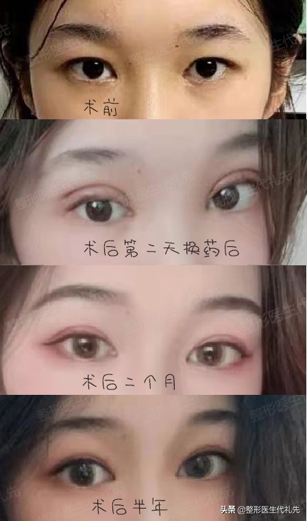 聊一聊眼睛手术,双眼皮怎么选看完你就知道了