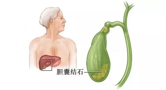 为何胆结石容易在秋冬夜间发作,胆结石为何总在夜间发作