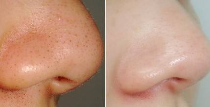 脸上的黑头和草莓鼻怎么快速解决,黑头草莓脸怎么改善