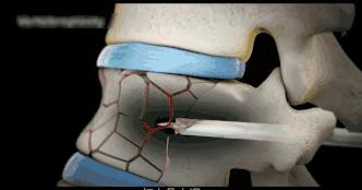 老年人腰部压缩性骨折怎么治疗,腰部压缩骨折多久才能恢复