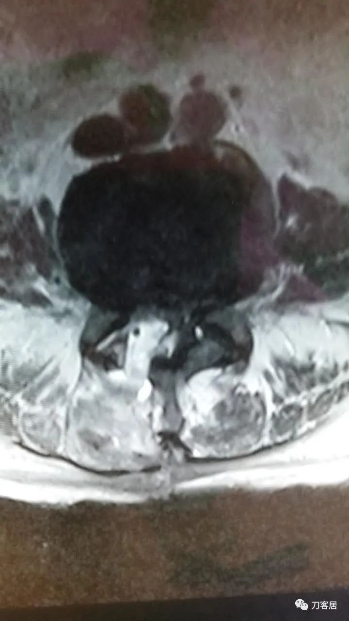 腰椎手术切掉棘突,腰突微创后出血肿