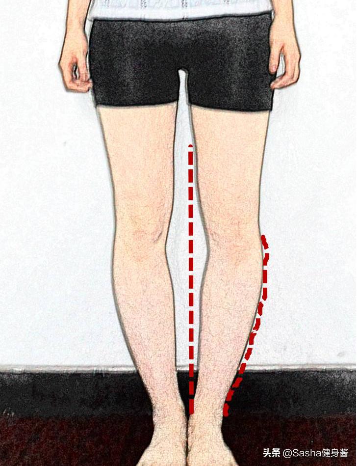 如何有效矫正o型腿,正确矫正o型腿的方法