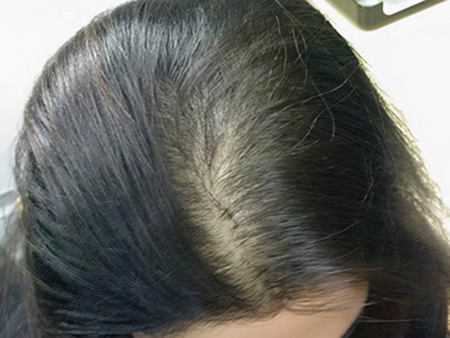 怀孕期间吃叶酸对胎儿有什么好处,坚持吃叶酸片有副作用吗