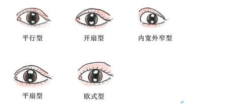常见的几种双眼皮,常见双眼皮的手术方法及利弊
