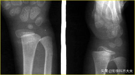 骨折的影像学检查及各自的优势,骨折的影像学愈合标准