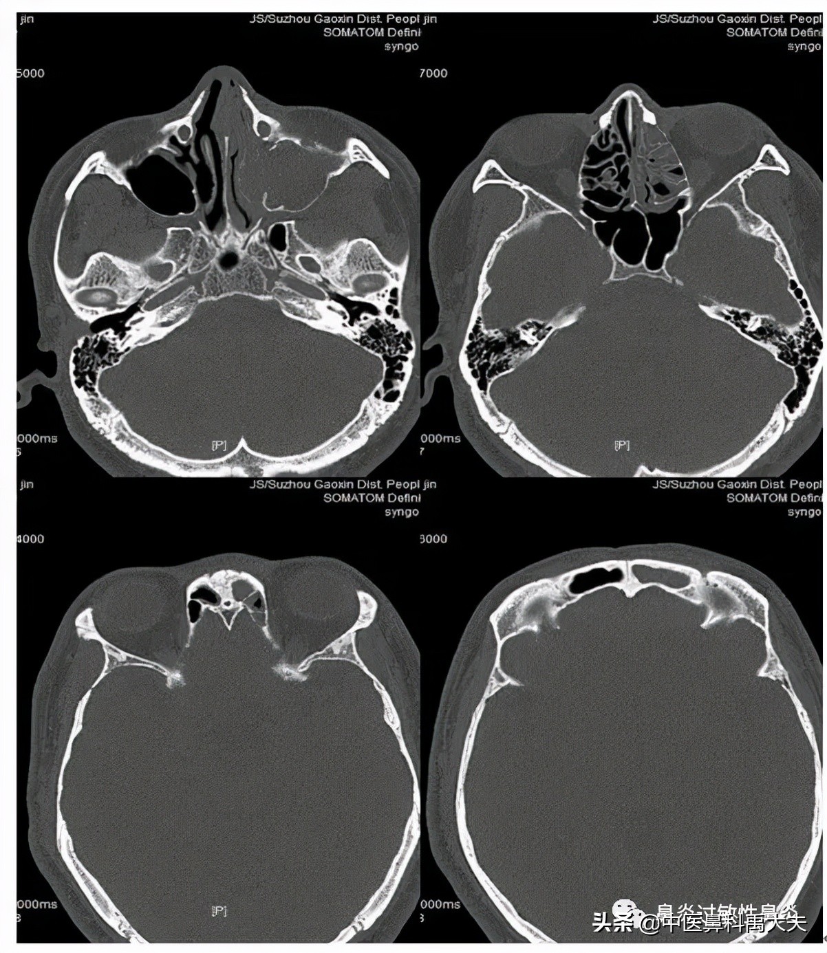 鼻窦炎怎么治疗好得快,鼻窦炎的治疗原则是