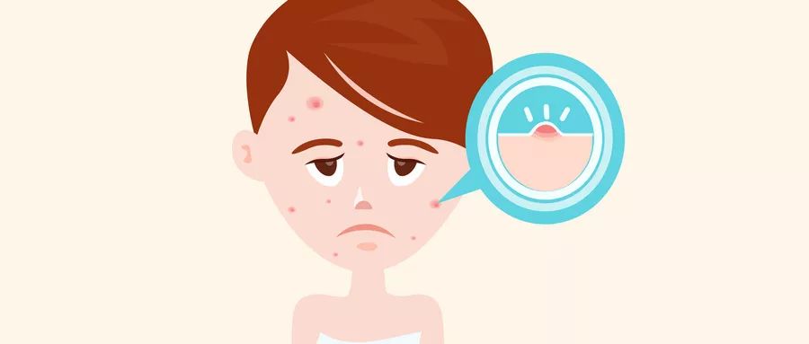 痘痘怎么防治小妙招,痘痘怎么治疗最快最有效