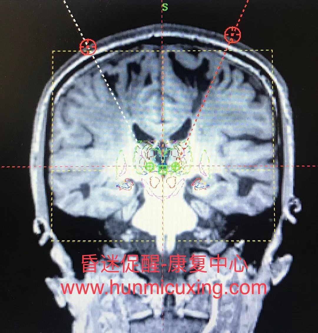 妞嶇墿浜哄ぇ鑴戠殑娈嬪瓨鎰忚瘑,妞嶇墿浜虹殑娈嬪瓨鎰忚瘑