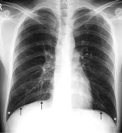 正常胸片图片,正常的胸片讲解