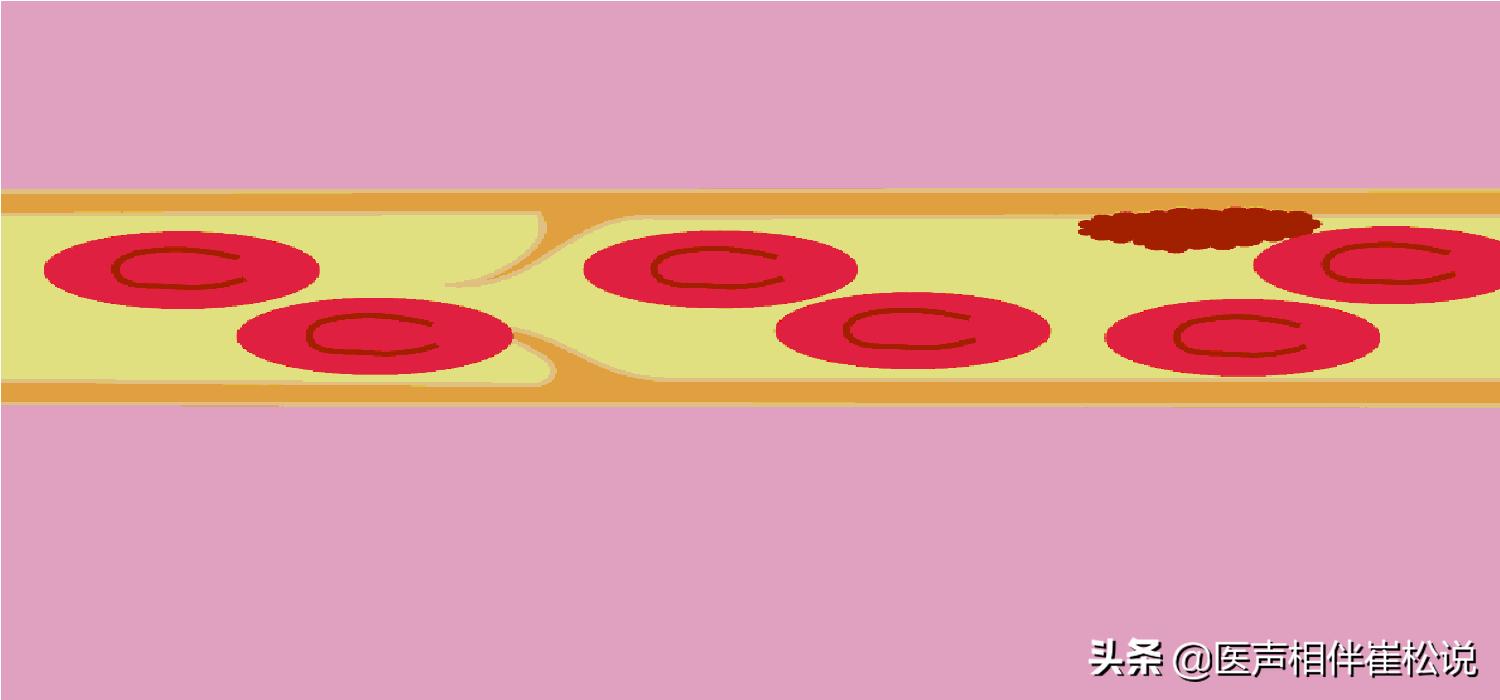 脑梗腔梗应该挂号什么科,腔梗和脑梗有什么区别