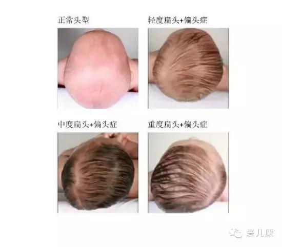 婴儿头型睡偏了几个月纠正来得及,如何防止宝宝头型睡偏