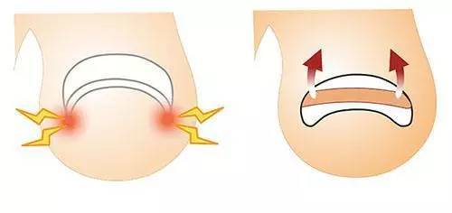 甲沟炎怎么自己修剪,甲沟炎修剪过程怎么缓解疼痛
