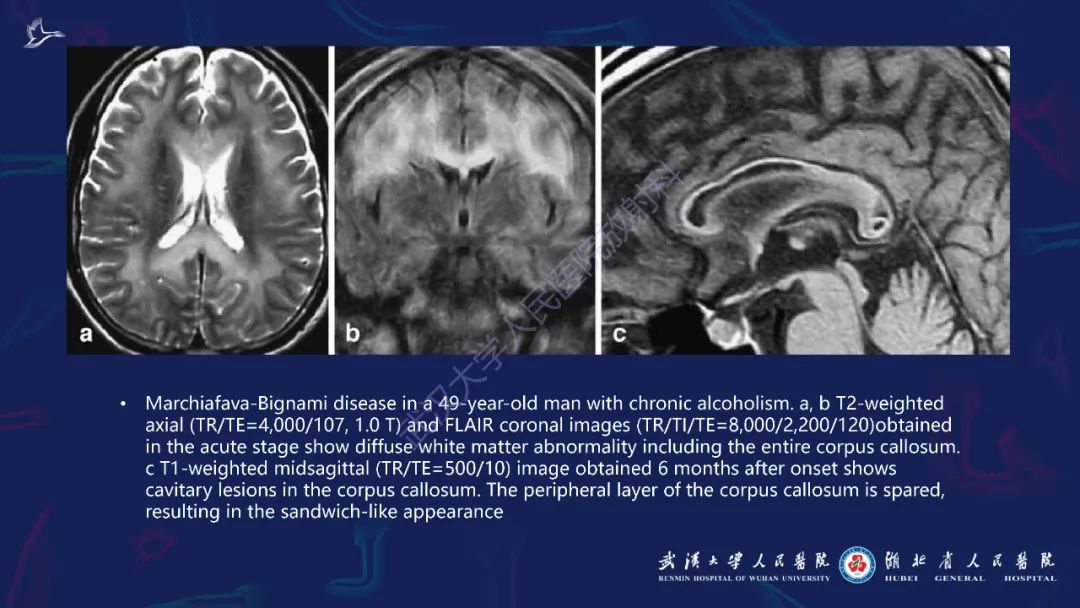 胼胝体肿瘤影像鉴别,胼胝体病变影像诊断