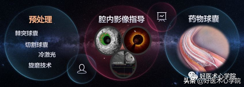 安贞医院冠心病介入治疗新技术,冠心病介入术