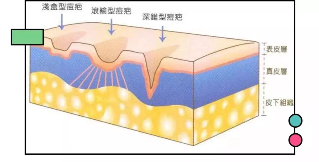 痘印多久才能消如何快速消除痘印,如何有效祛痘印看完你就知道了