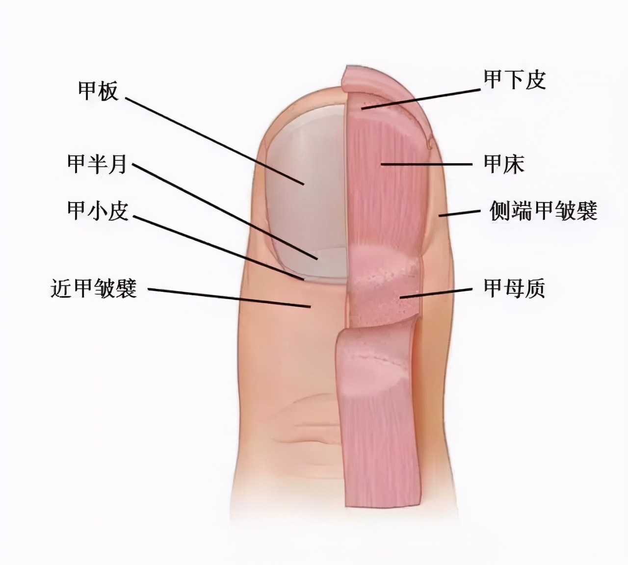 指甲剪得太短得甲沟炎,指甲剪的太短引起的甲沟炎