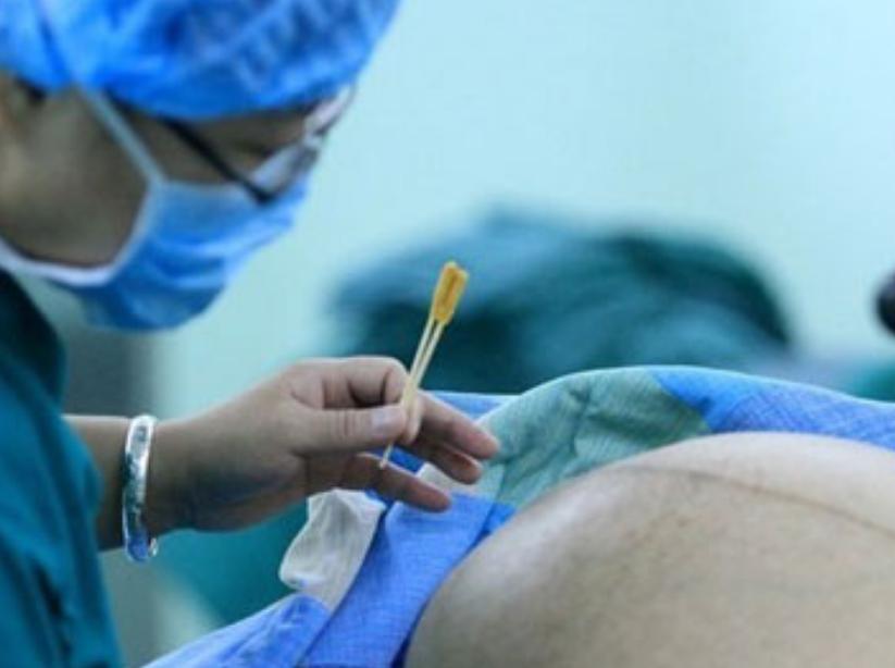 剖腹产不打麻醉备受折磨,剖腹产疼多久就彻底不疼了