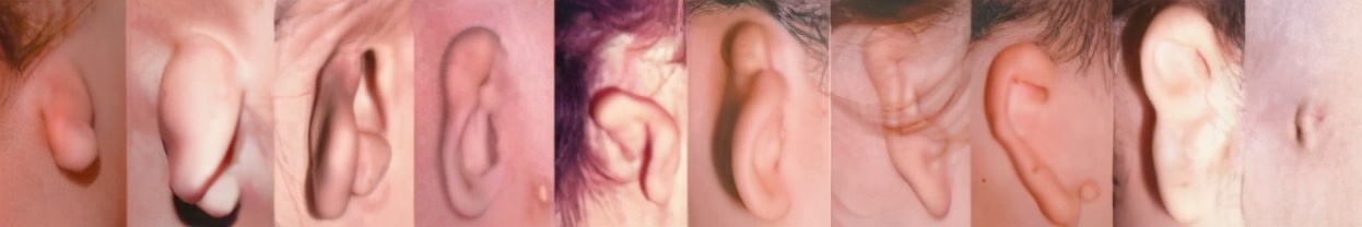 余文林小耳畸形失败案例,成人耳朵畸形能矫正吗效果怎么样