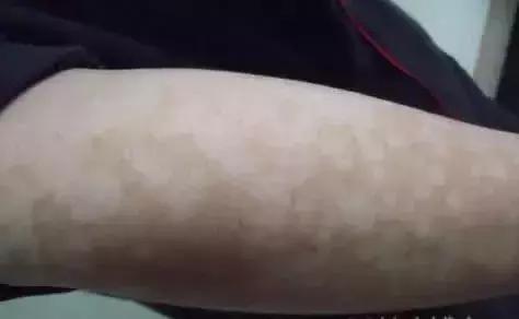 治疗真菌性皮肤病的中药方子,真菌皮肤病的书籍